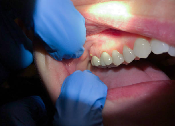 Best Emergency Root Canal Treatment in Middleport, OH